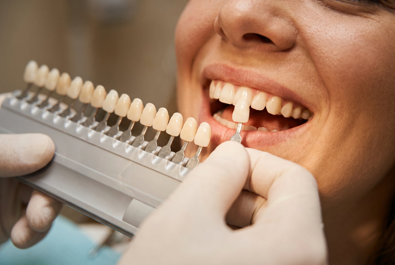 Dentist matching ceramic crown shade to a patient's natural teeth using a shade guide in a Reseda dental office