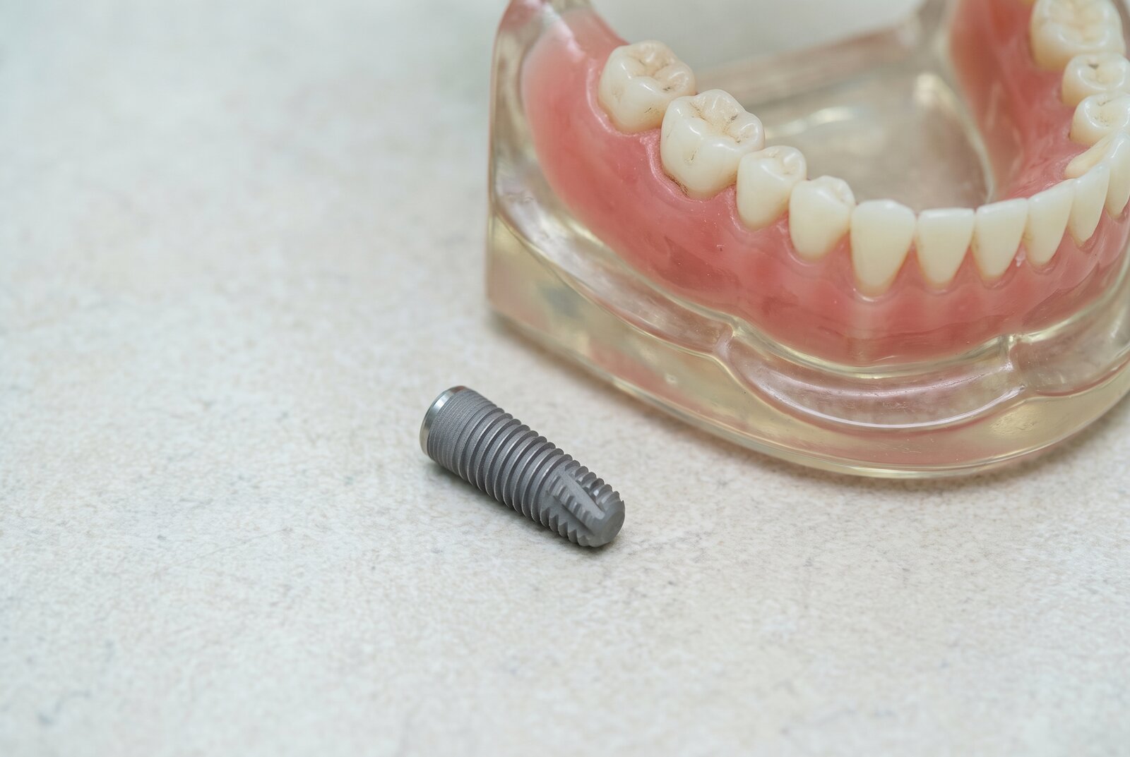Macro photo of a titanium dental implant post beside a jaw model in a Reseda dental office