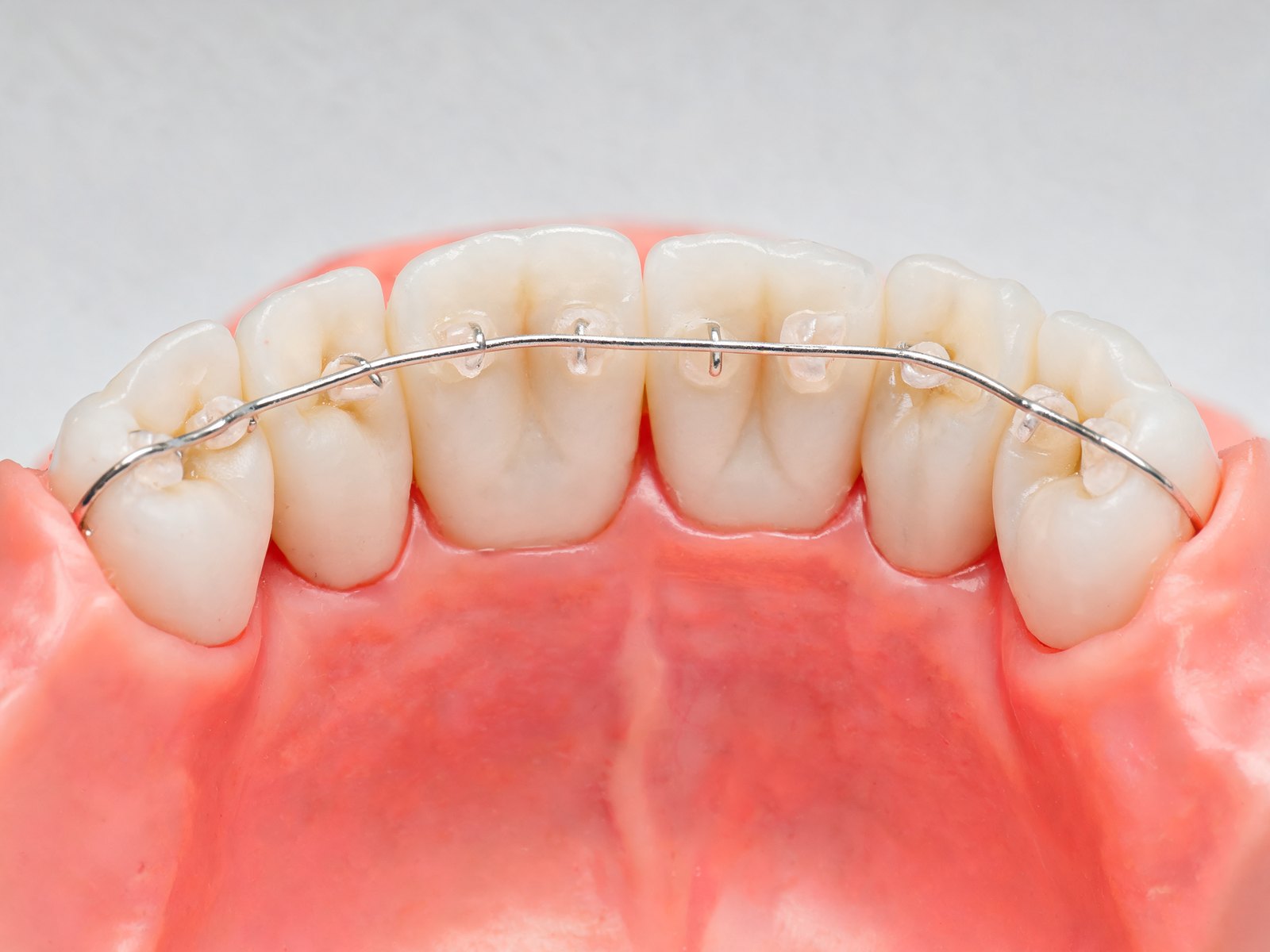 Dental model showing a thin bonded wire retainer behind the lower front teeth