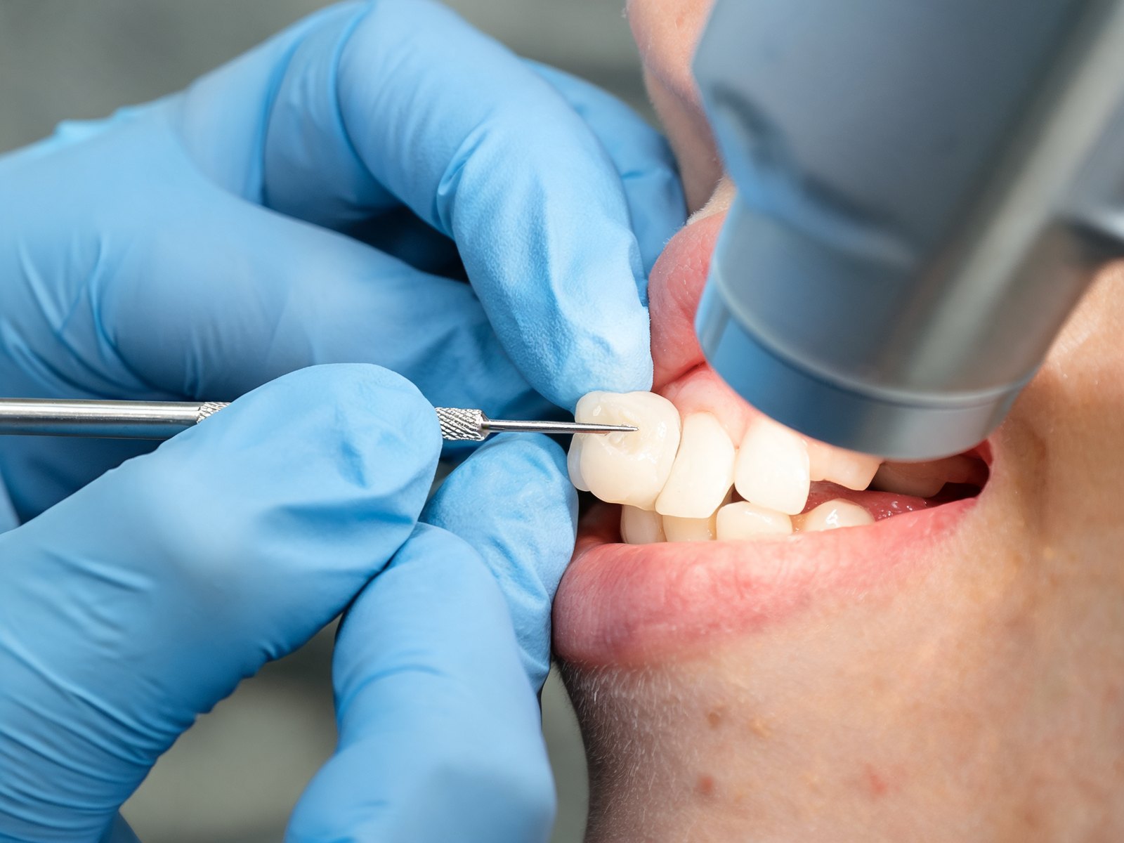 Dentist shaping tooth colored resin on a front tooth during dental bonding